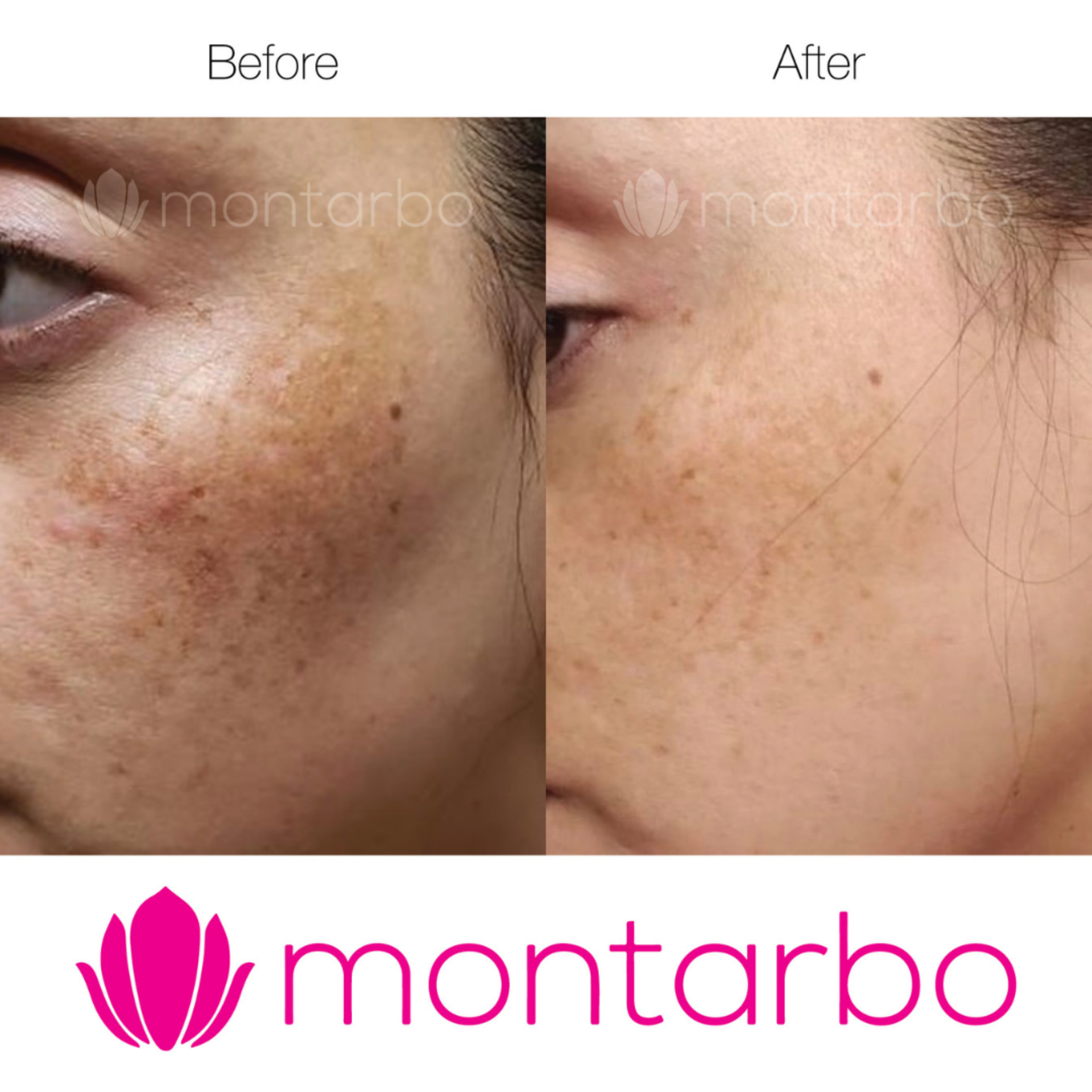 BEFORE AND AFTER PIGMENTATION MONATRBO SKINCARE 